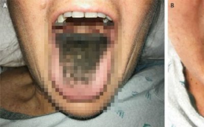 Mulher desenvolve caso raro de 'língua peluda' nos Estados Unidos.