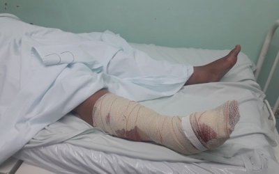 Mulher é atacada por Pitbull e sofre ferimento grave na perna