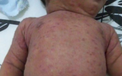 Sarna humana volta a preocupar e bebê de 2 meses é internado