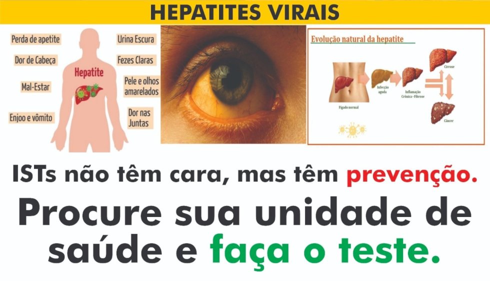 Secretaria de saúde de Ivinhema faz alerta sobre Hepatites Virais