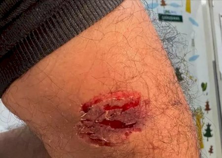 Paciente em surto morde profissional da saúde durante atendimento