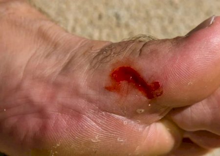 Nova Andradina registra a primeira morte por tétano em 2026